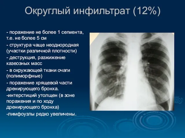 Округлый инфильтрат (12%) - поражение не более 1 сегмента, т.е. не