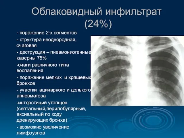 Облаковидный инфильтрат (24%) - поражение 2-х сегментов - структура неоднородная, очаговая