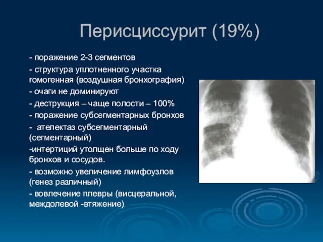 Перисциссурит (19%) - поражение 2-3 сегментов - структура уплотненного участка гомогенная