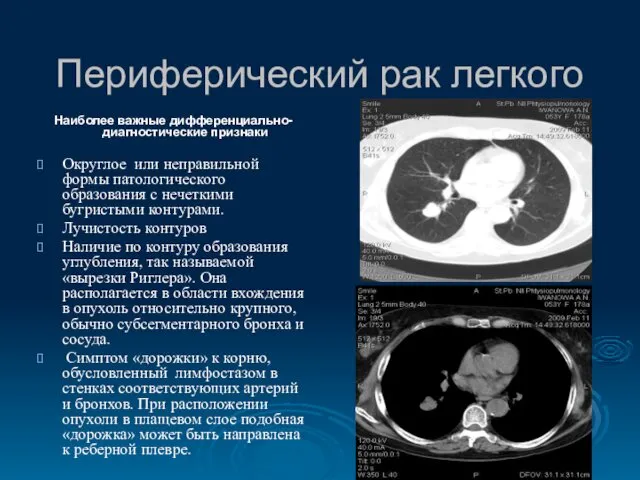 Периферический рак легкого Наиболее важные дифференциально-диагностические признаки Округлое или неправильной формы