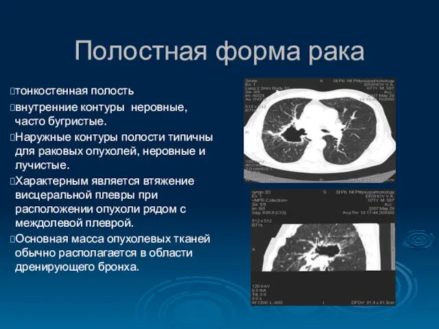 Полостная форма рака тонкостенная полость внутренние контуры неровные, часто бугристые. Наружные