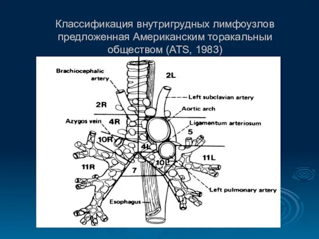 Классификация внутригрудных лимфоузлов предложенная Американским торакальныи обществом (ATS, 1983)