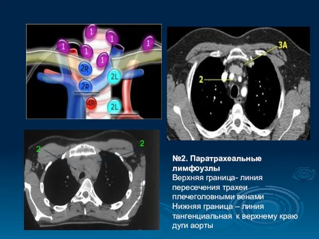№2. Паратрахеальные лимфоузлы Верхняя граница- линия пересечения трахеи плечеголовными венами Нижняя