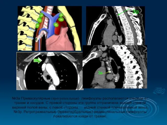 №3а Преваскулярные (претрахеальные) лимфоузлы располагаются кпереди от трахеи и сосудов. С
