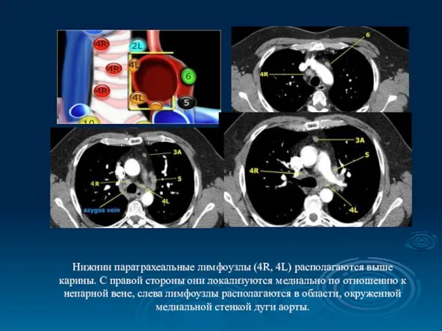 Нижнии паратрахеальные лимфоузлы (4R, 4L) располагаются выше карины. С правой стороны