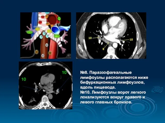 №8. Параэзофагеальные лимфоузлы располагаются ниже бифуркационных лимфоузлов, вдоль пищевода. №10. Лимфоузлы