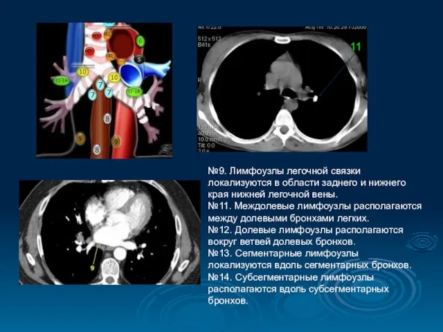 №9. Лимфоузлы легочной связки локализуются в области заднего и нижнего края