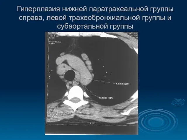 Гиперплазия нижней паратрахеальной группы справа, левой трахеобронхиальной группы и субаортальной группы