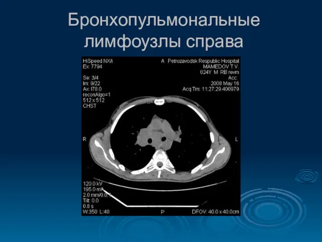 Бронхопульмональные лимфоузлы справа