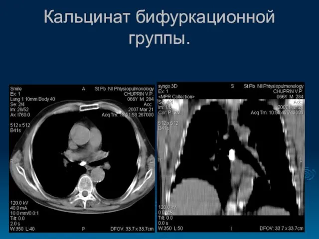 Кальцинат бифуркационной группы.