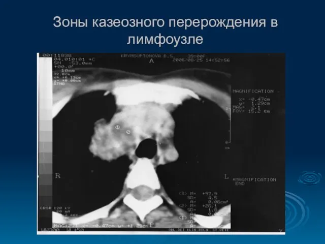 Зоны казеозного перерождения в лимфоузле