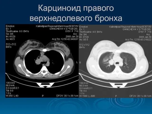 Карциноид правого верхнедолевого бронха