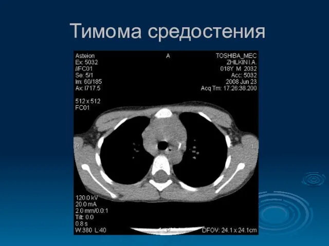 Тимома средостения