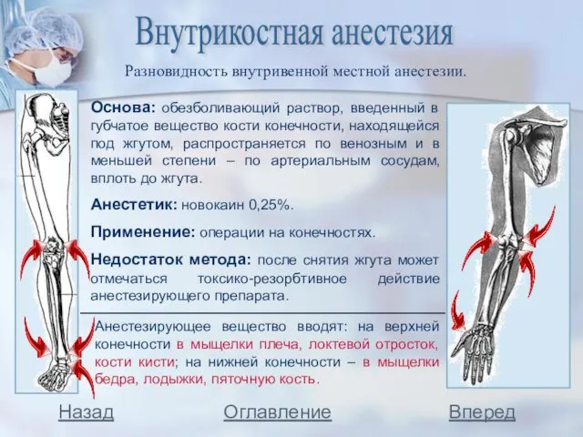 Внутрикостная анестезия Основа: обезболивающий раствор, введенный в губчатое вещество кости конечности,