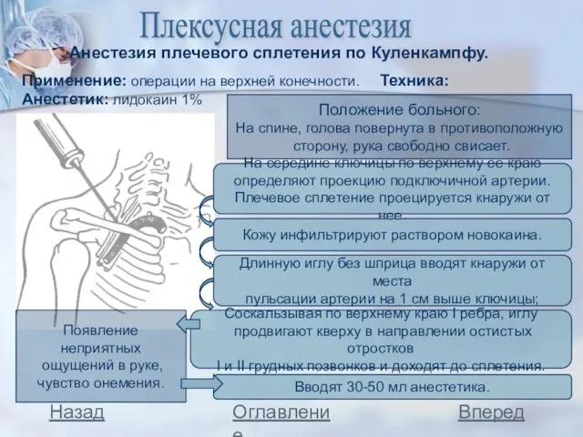 Плексусная анестезия Анестезия плечевого сплетения по Куленкампфу. Применение: операции на верхней