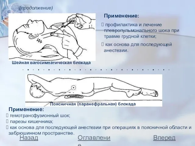 (продолжение) Шейная вагосимпатическая блокада Применение: профилактика и лечение плевропульмонального шока при