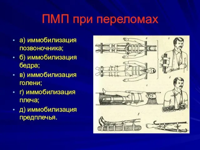 ПМП при переломах а) иммобилизация позвоночника; б) иммобилизация бедра; в) иммобилизация