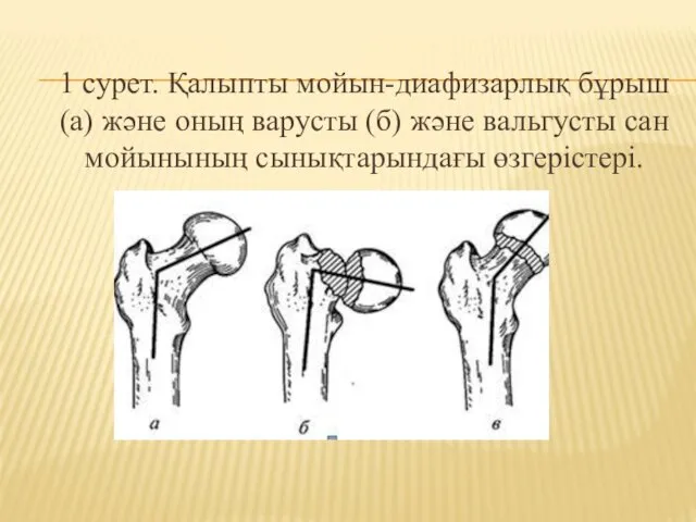 1 сурет. Қалыпты мойын-диафизарлық бұрыш (а) және оның варусты (б) және вальгусты сан мойынының сынықтарындағы өзгерістері.