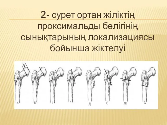 2- сурет ортан жіліктің проксимальды бөлігінің сынықтарының локализациясы бойынша жіктелуі