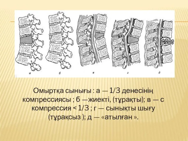 Омыртқа сынығы : а — 1/3 денесінің компрессиясы ; б —жиекті, (тұрақты); в — с компрессия