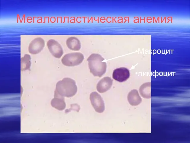Мегалопластическая анемия Макроцит лимфоцит