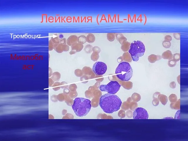 Лейкемия (AML-M4) Тромбоцит Mиелобласт
