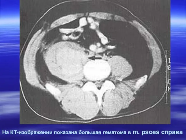 На КТ-изображении показана большая гематома в m. psoas справа