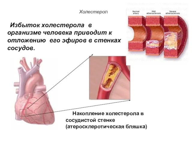 Холестерол Накопление холестерола в сосудистой стенке (атеросклеротическая бляшка) Избыток холестерола в