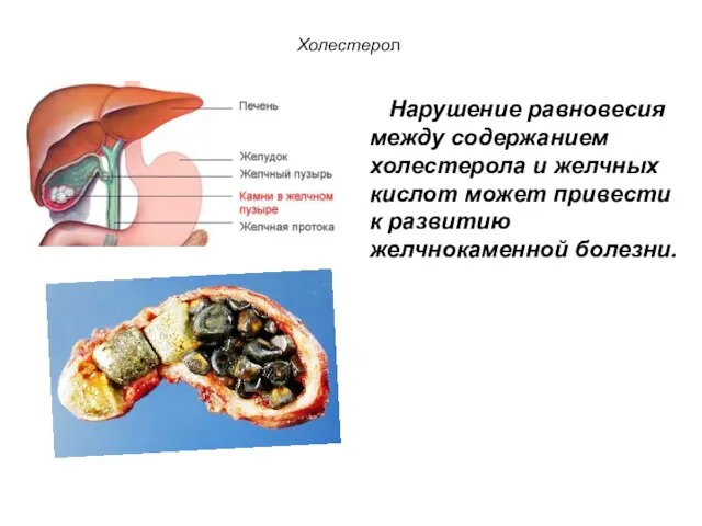 Холестерол Нарушение равновесия между содержанием холестерола и желчных кислот может привести к развитию желчнокаменной болезни.