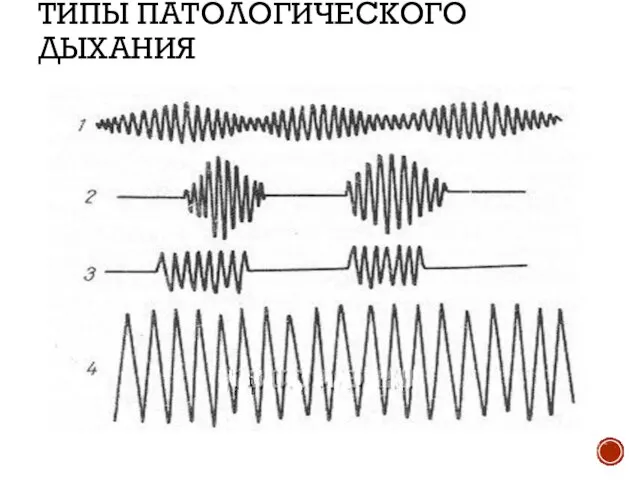 ТИПЫ ПАТОЛОГИЧЕСКОГО ДЫХАНИЯ