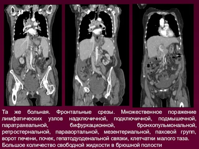 Та же больная. Фронтальные срезы. Множественное поражение лимфатических узлов надключичной, подключичной,