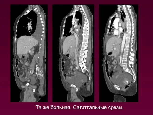 Та же больная. Сагиттальные срезы.