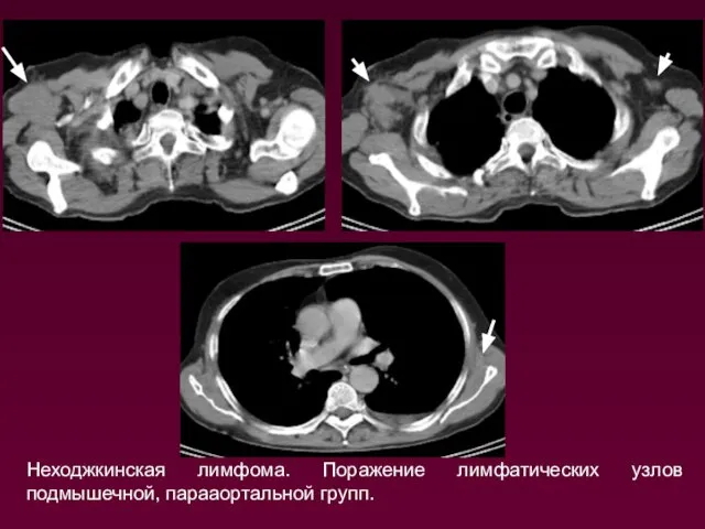 Неходжкинская лимфома. Поражение лимфатических узлов подмышечной, парааортальной групп.