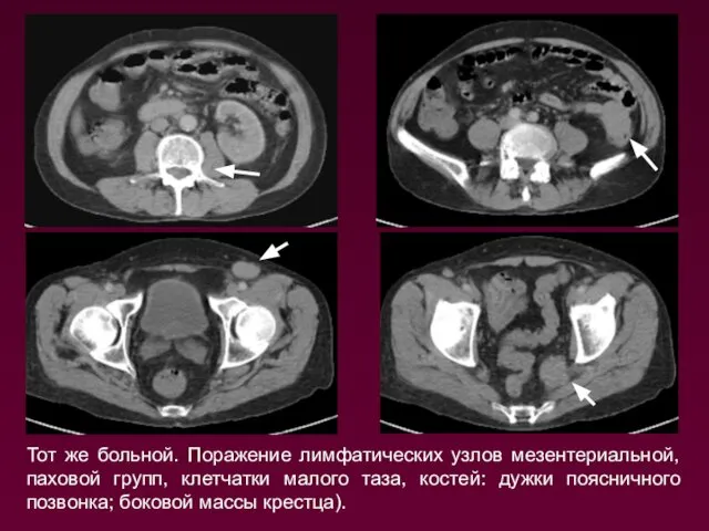 Тот же больной. Поражение лимфатических узлов мезентериальной, паховой групп, клетчатки малого