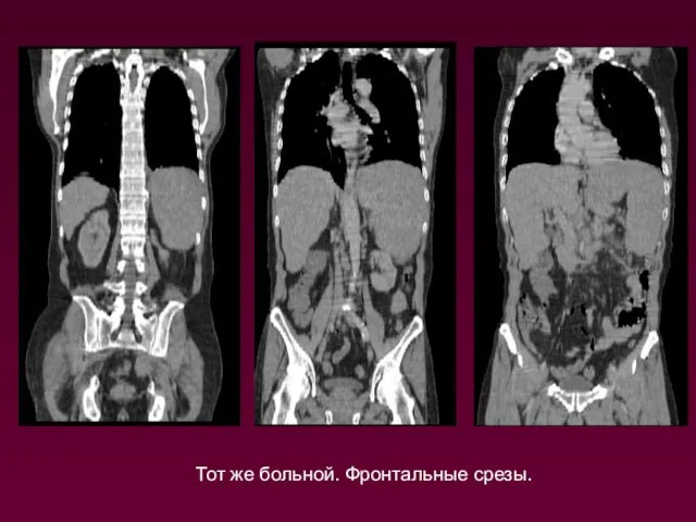Тот же больной. Фронтальные срезы.