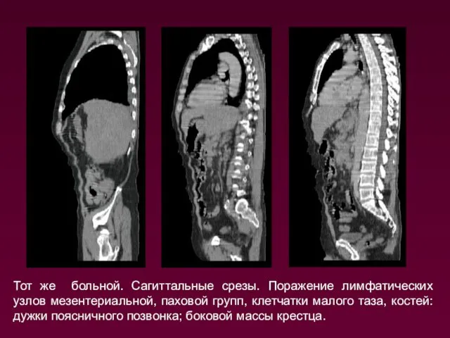 Тот же больной. Сагиттальные срезы. Поражение лимфатических узлов мезентериальной, паховой групп,