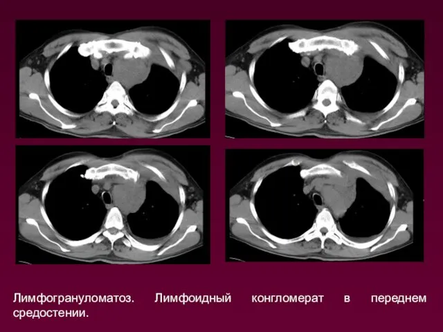 Лимфогрануломатоз. Лимфоидный конгломерат в переднем средостении.