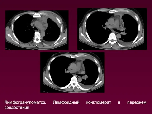 Лимфогрануломатоз. Лимфоидный конгломерат в переднем средостении.