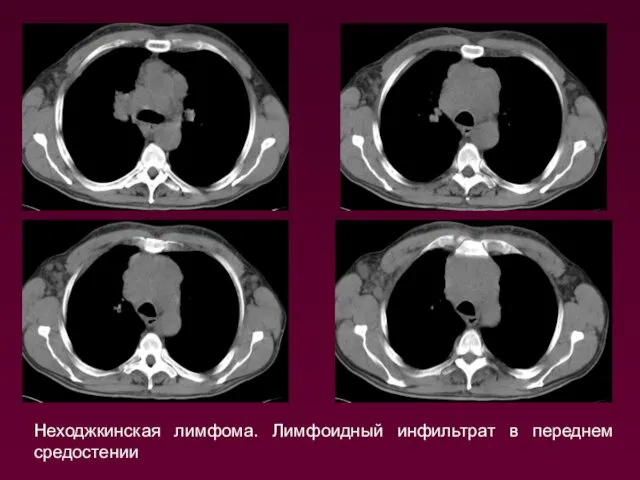 Неходжкинская лимфома. Лимфоидный инфильтрат в переднем средостении