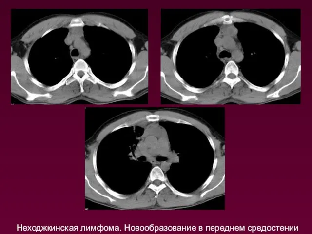 Неходжкинская лимфома. Новообразование в переднем средостении