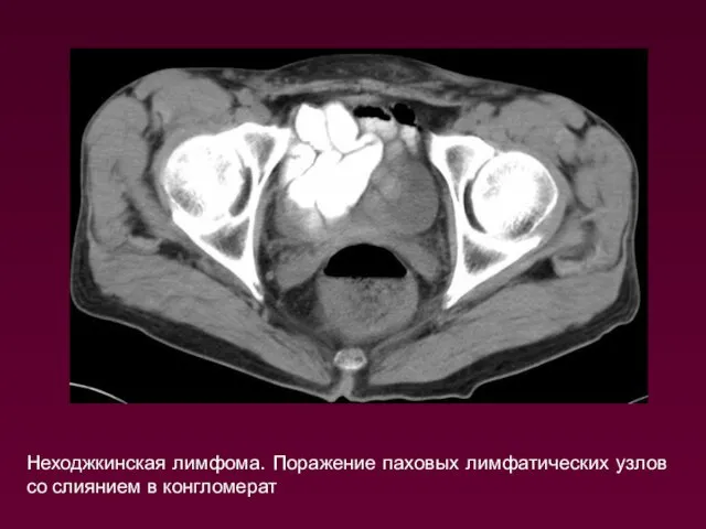 Неходжкинская лимфома. Поражение паховых лимфатических узлов со слиянием в конгломерат