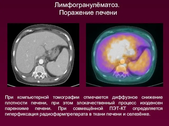 Лимфогранулёматоз. Поражение печени При компьютерной томографии отмечается диффузное снижение плотности печени,