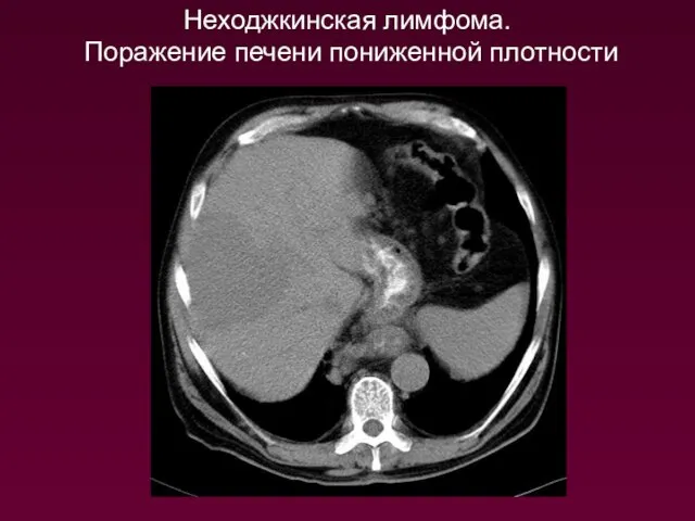 Неходжкинская лимфома. Поражение печени пониженной плотности