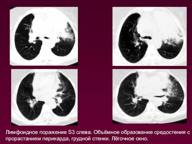 Лимфоидное поражение S3 слева. Объёмное образование средостения с прорастанием перикарда, грудной стенки. Лёгочное окно.