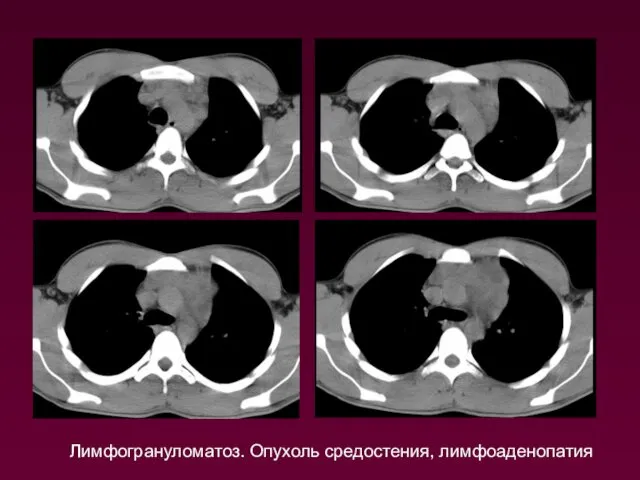 Лимфогрануломатоз. Опухоль средостения, лимфоаденопатия