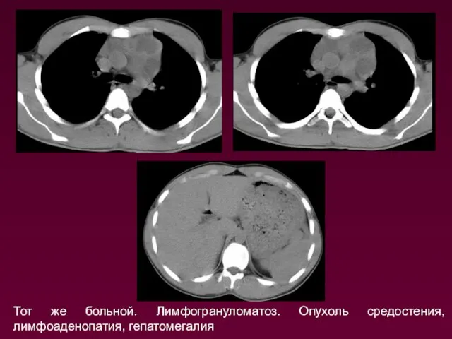 Тот же больной. Лимфогрануломатоз. Опухоль средостения, лимфоаденопатия, гепатомегалия