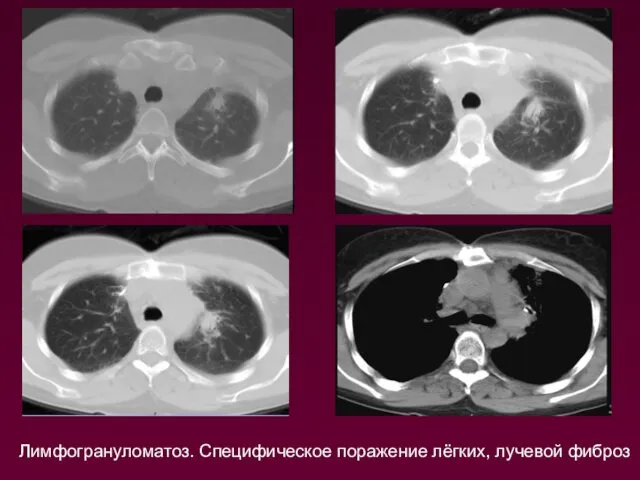 Лимфогрануломатоз. Специфическое поражение лёгких, лучевой фиброз