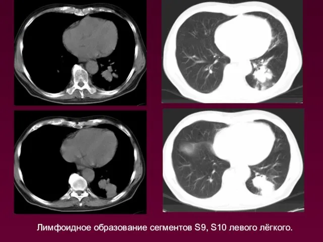 Лимфоидное образование сегментов S9, S10 левого лёгкого.