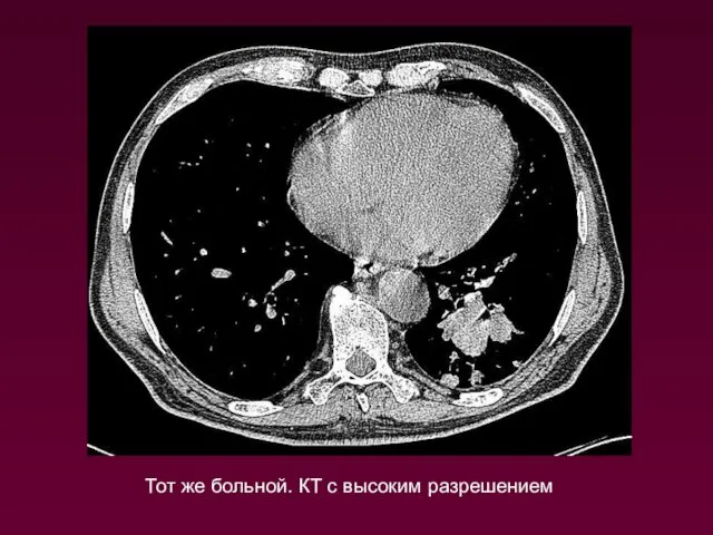 Тот же больной. КТ с высоким разрешением