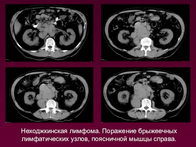 Неходжкинская лимфома. Поражение брыжеечных лимфатических узлов, поясничной мышцы справа.